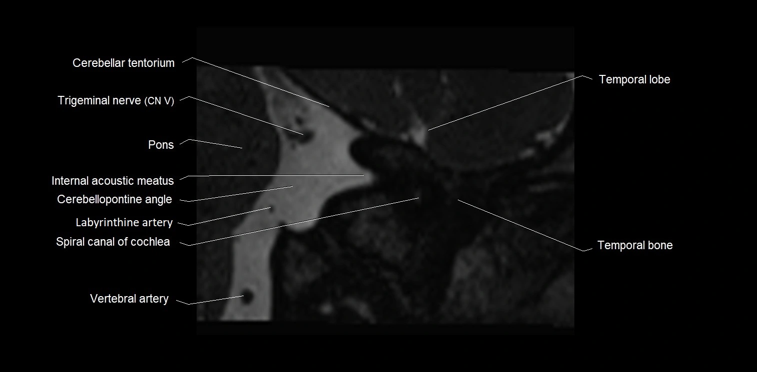 Internal auditory meatus (IAM) axial cross sectional anatomy image 1.webp